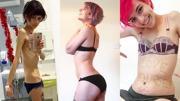 Una joven muestra en fotos cómo se recupera de la anorexia: «Se puede volver a ser feliz»