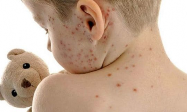 La aparición de enfermedades eruptivas en los más chicos y la primavera