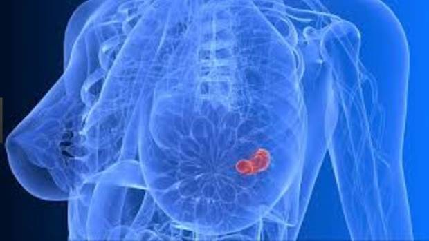 Argentina aprobó una droga que frena avance de un tipo de cáncer de mama frecuente