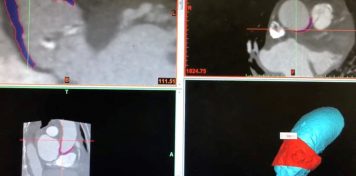 Planearon en 3D una operación cardíaca de riesgo y lograron que el paciente se recuperara más rápido