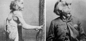 Hace 129 años moría Joseph Merrick, el apodado «Hombre elefante» que dejó un aleccionador poema para quienes se burlaron de él