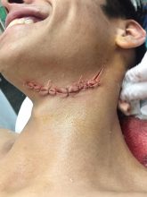 Herida en el cuello: La profesional del hospital hizo su descargo