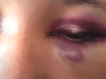 SÁENZ PEÑA | Habló la joven víctima de la brutal golpiza por chicas trans a la salida de un boliche