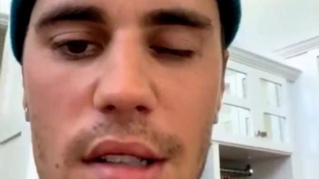 Justin Bieber sufre una parálisis facial tras ser diagnosticado con un raro trastorno: qué tiene