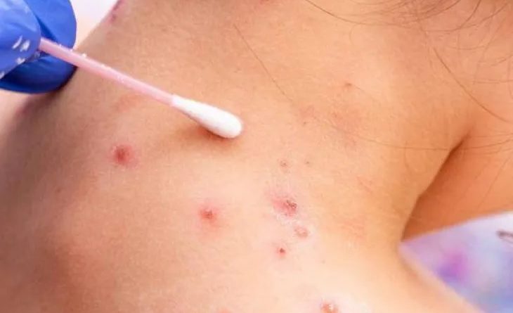 Analizan un caso sospechoso de viruela del mono en Zárate