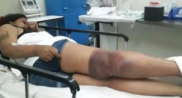 Una joven quiso consultar el saldo de la SUBE y se electrocutó: terminó internada y deberá ser operada