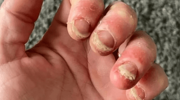 Una mujer sufre una pesadilla tras hacerse las uñas: “La piel está en carne viva”